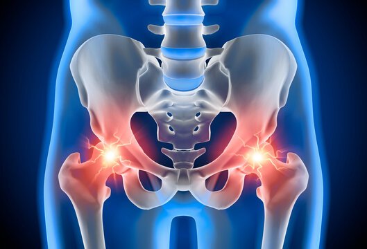 Hip Osteoarthritis