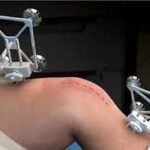 Top 10 Benefits of Robotic Knee Replacement Surgery | Advanced Knee Care