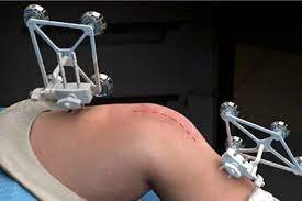 Top 10 Benefits of Robotic Knee Replacement Surgery | Advanced Knee Care